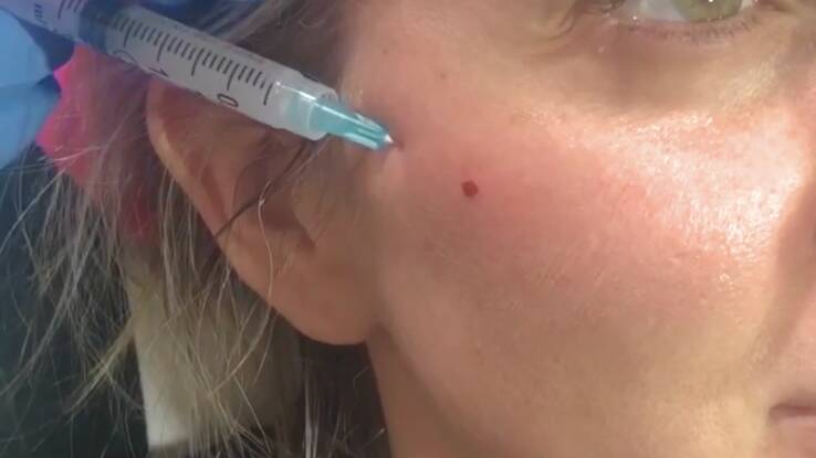 Cheek Fillers by Beauty Refined