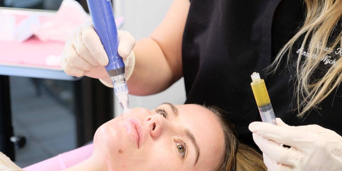 SkinPen microneedling device with PRP at Beauty Refined.