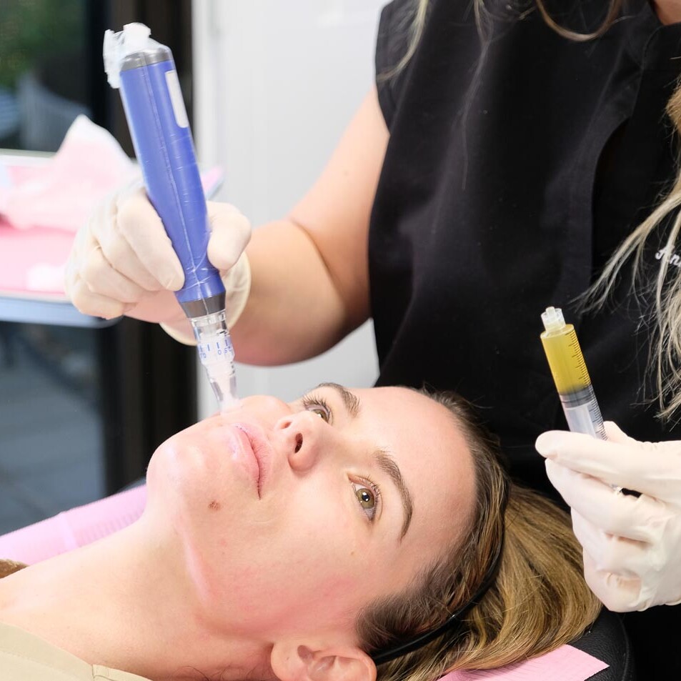 SkinPen microneedling device with PRP at Beauty Refined.