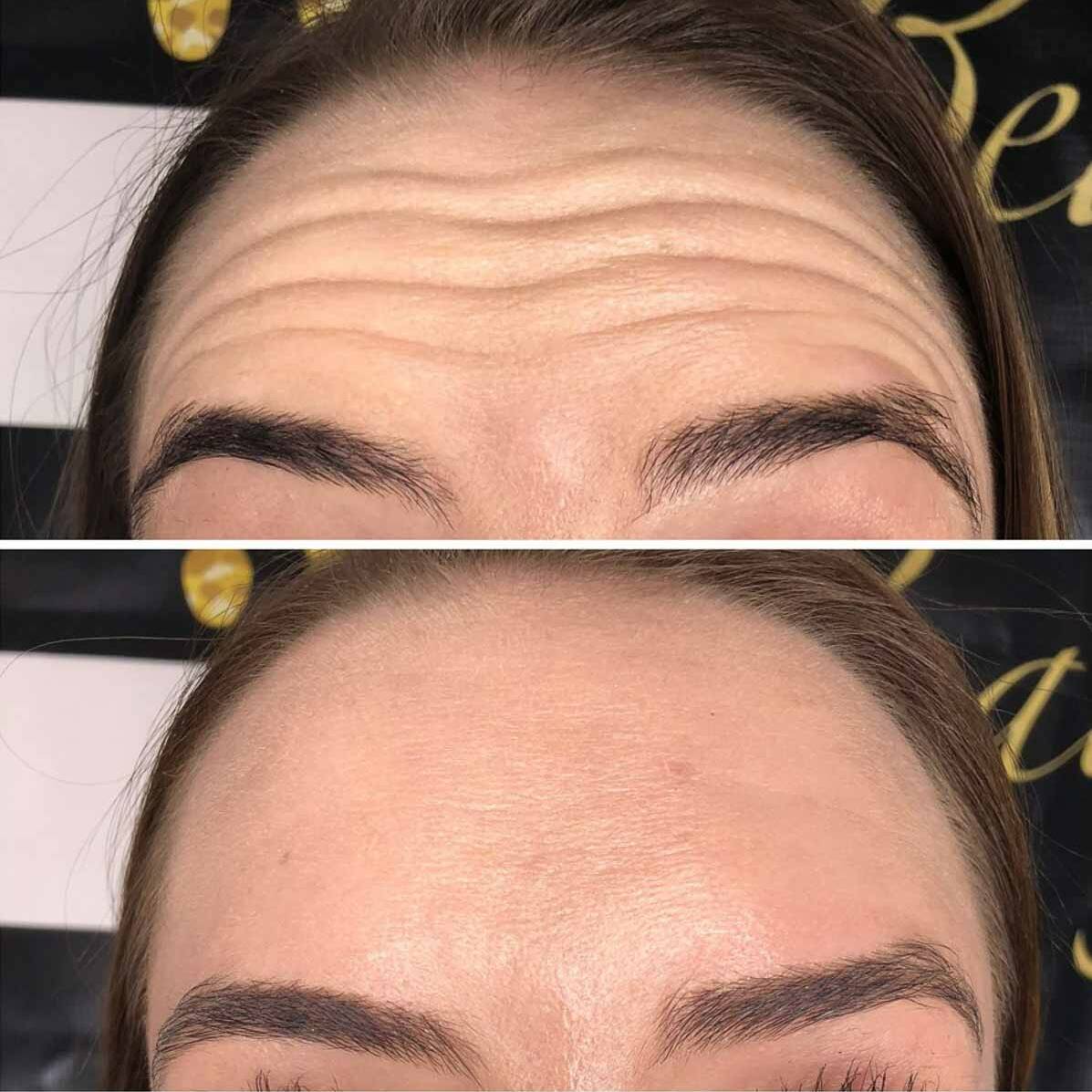 Neurotoxin 1 Forehead Lines | Beauty Refined in Denver Tech Center, & Parker Colorado