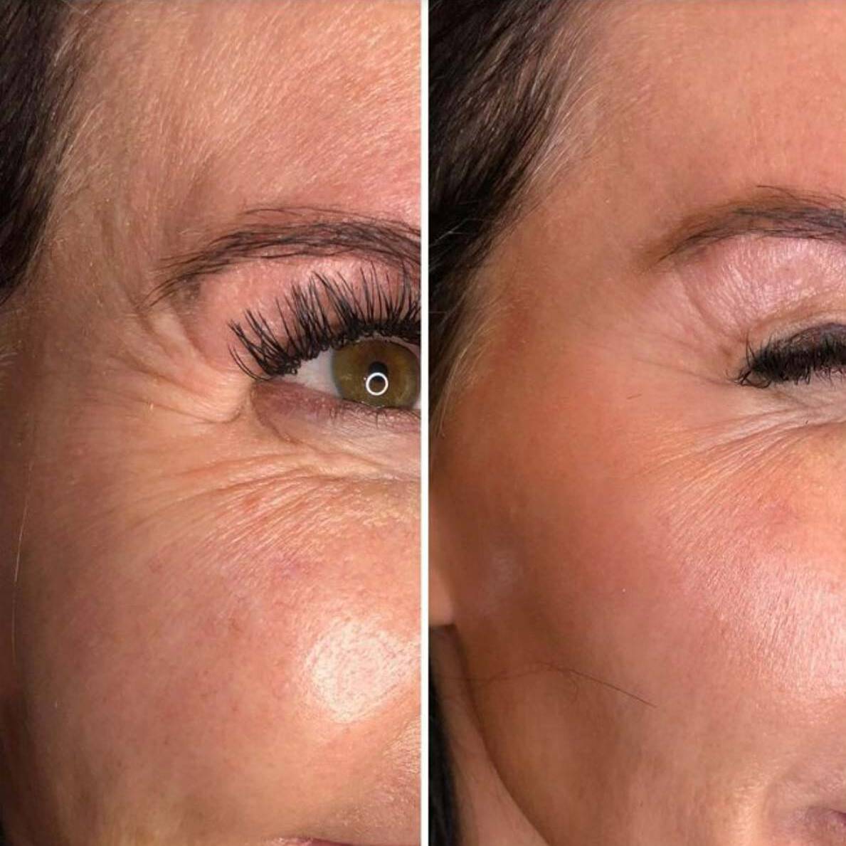 Neurotoxin 6 Crows Feet | Beauty Refined in Denver Tech Center, & Parker Colorado