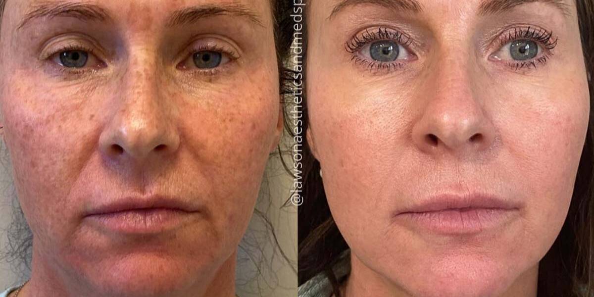 Before and After Cool peel Treatments in Denver Tech Center, & Parker Colorado