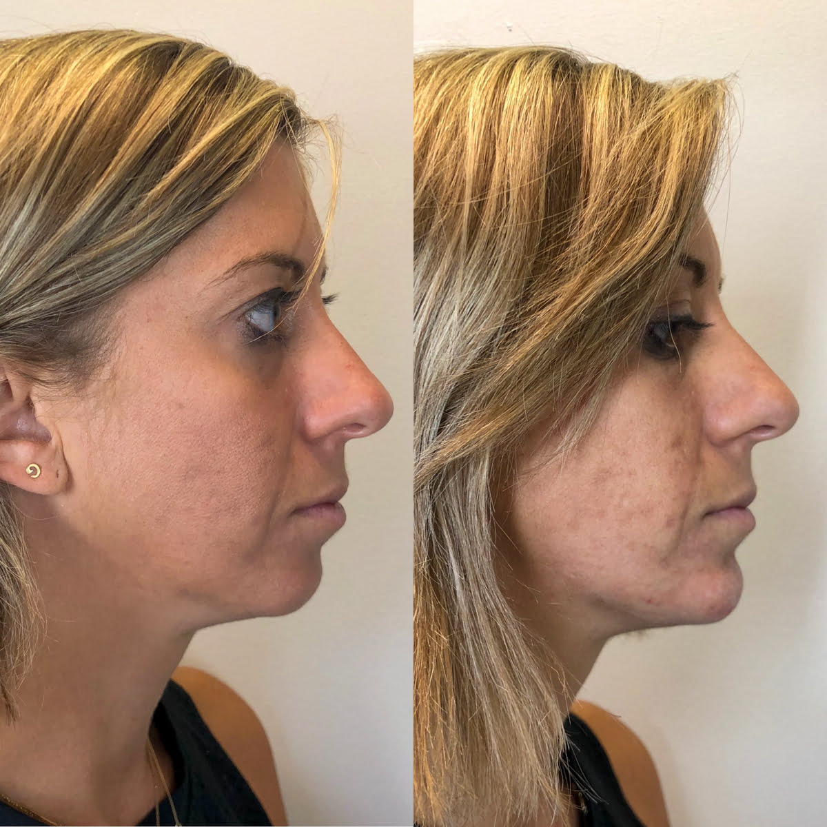 Chin & Lower Face Fillers | Before and After Gallery