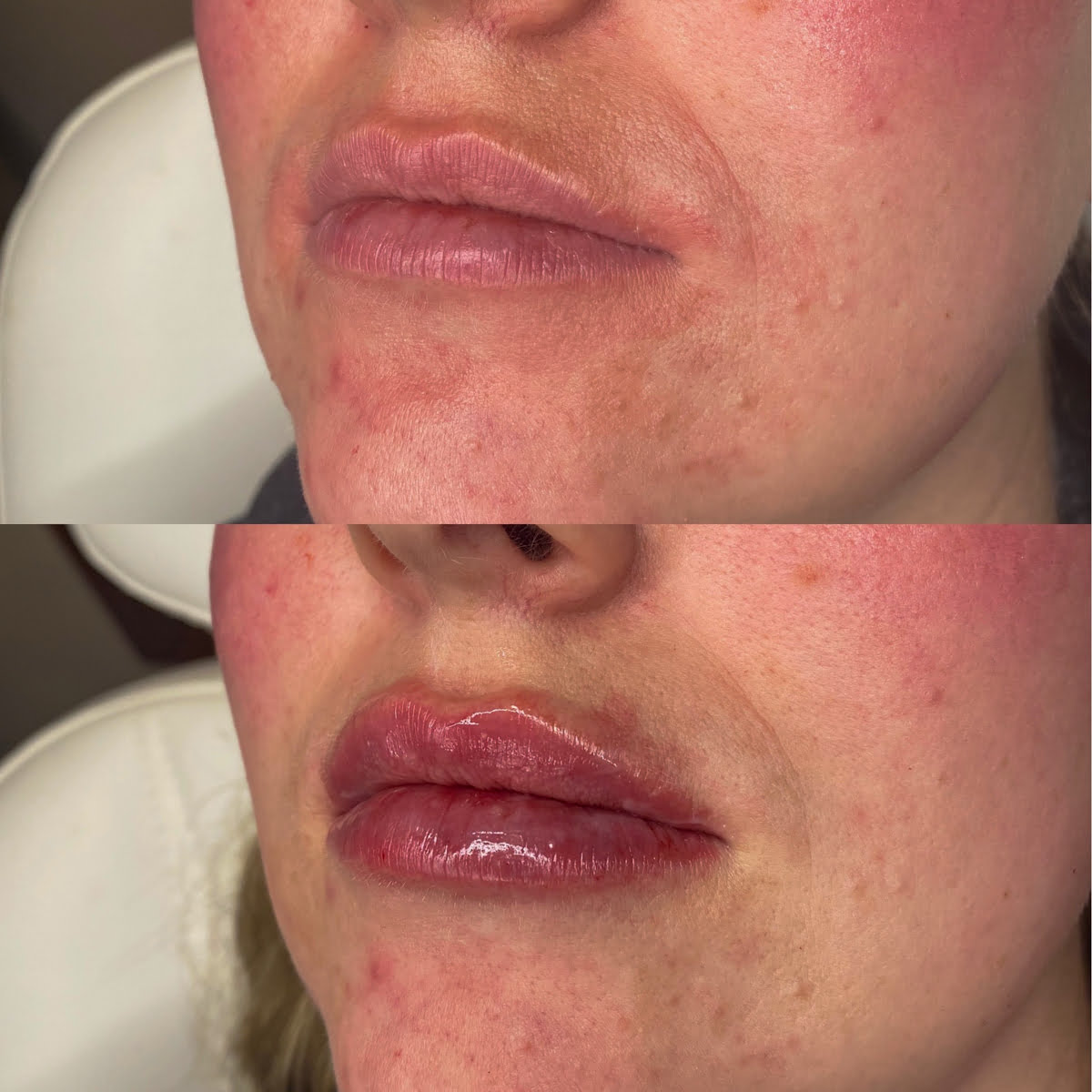Lip Fillers | Before and After Gallery