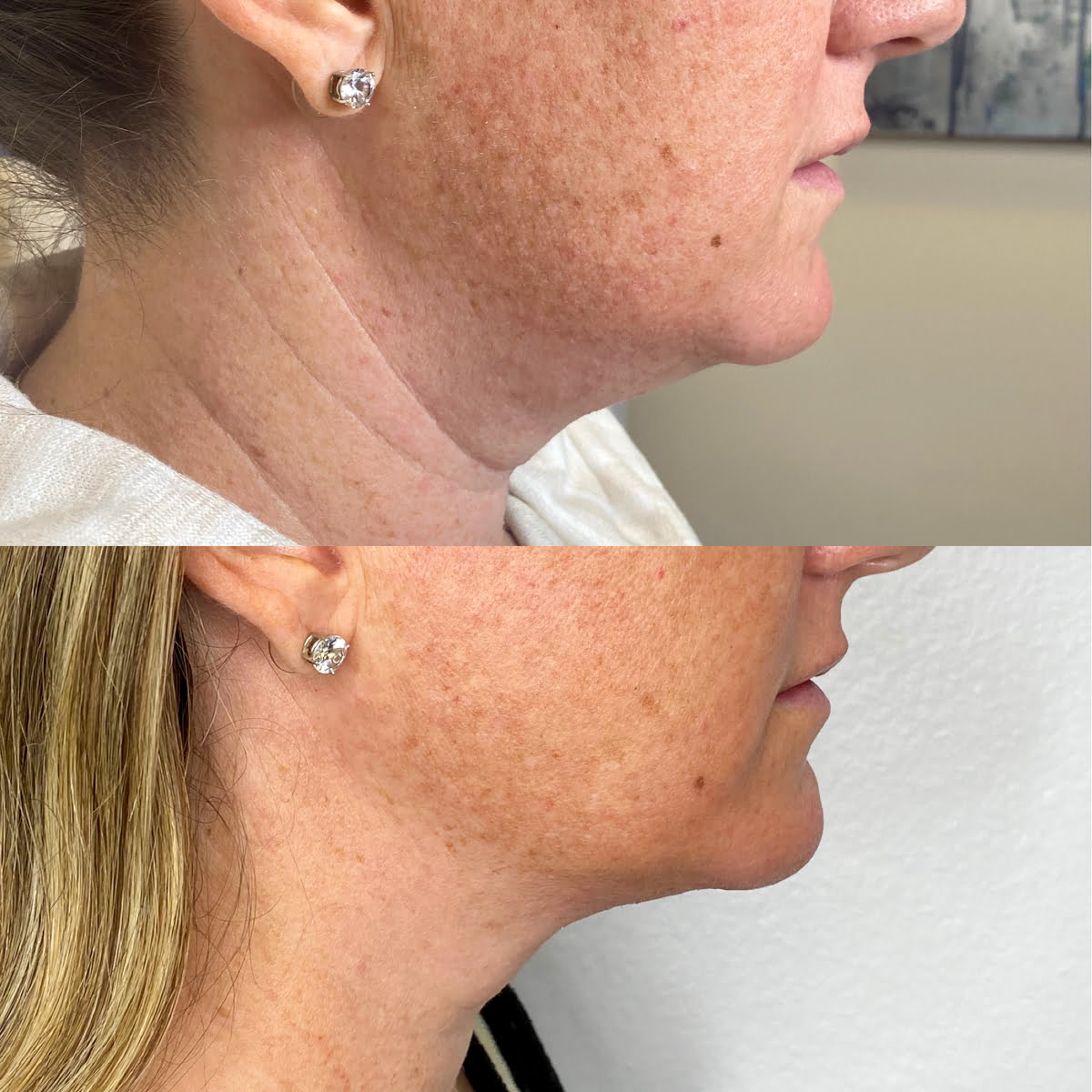 Kybella Injections | Before and After Gallery