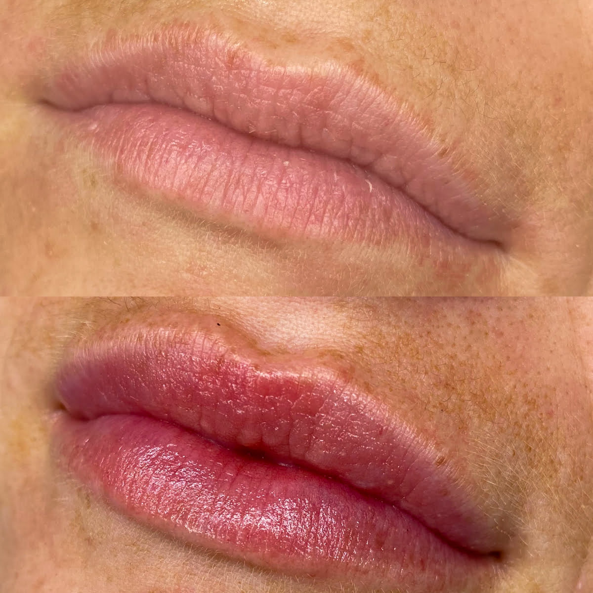 Lip Fillers | Before and After Gallery