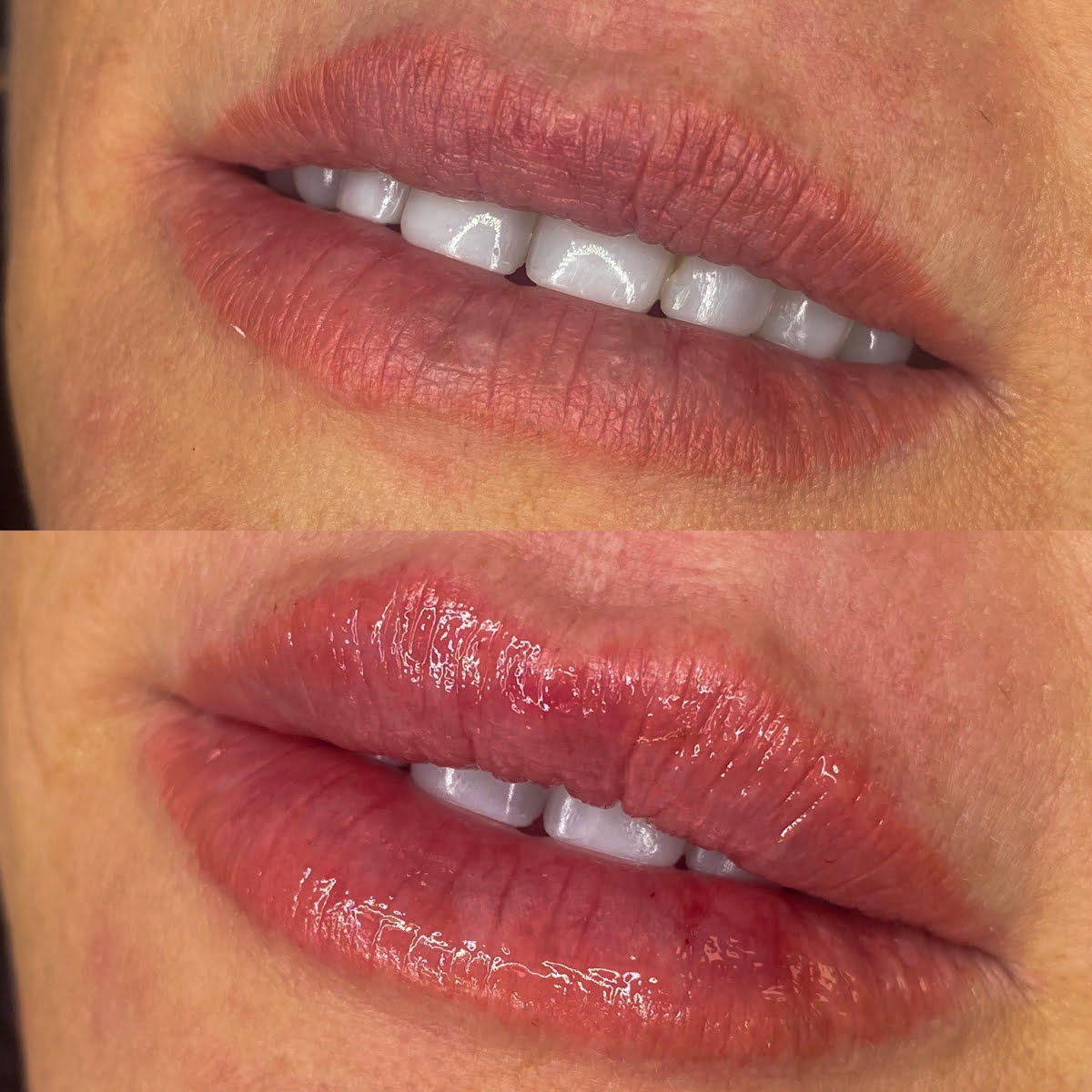 Lip Fillers | Before and After Gallery