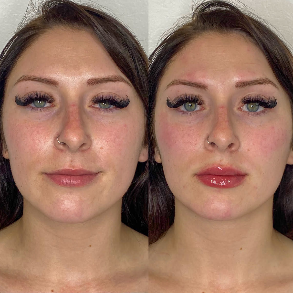 Cheek Under Eye Filler | Before and After Gallery