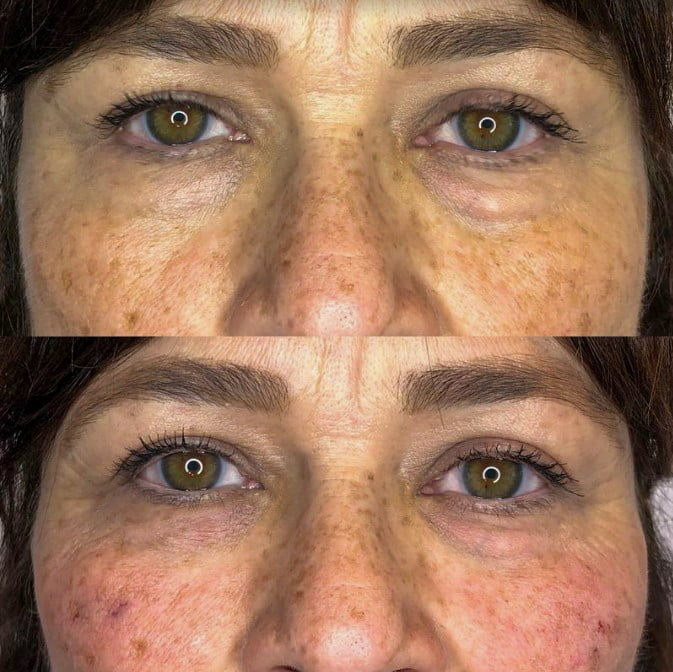 Cheek Under Eye Filler | Before and After Gallery | Beauty Refined