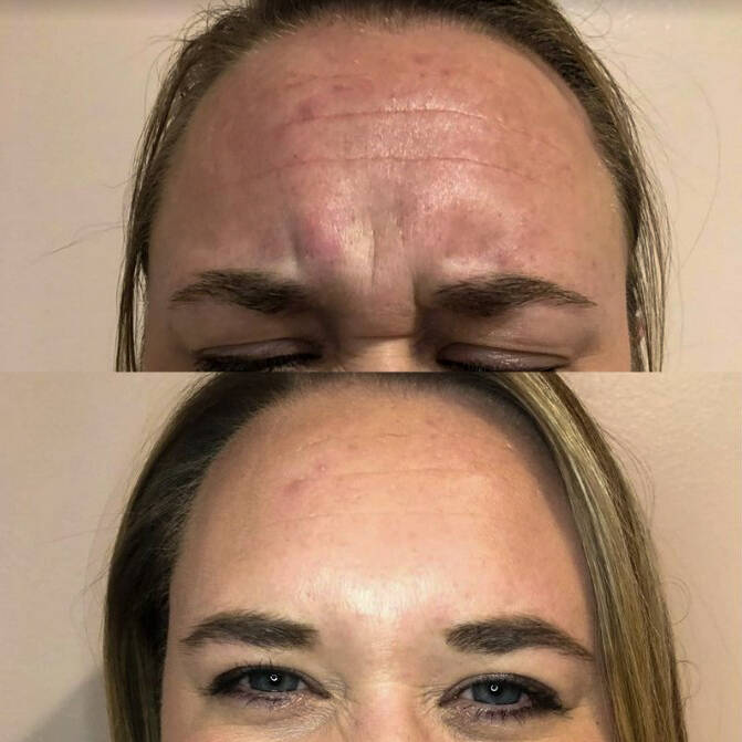 Neurotoxin for Forehead Lines | Before and After Gallery | Beauty Refined