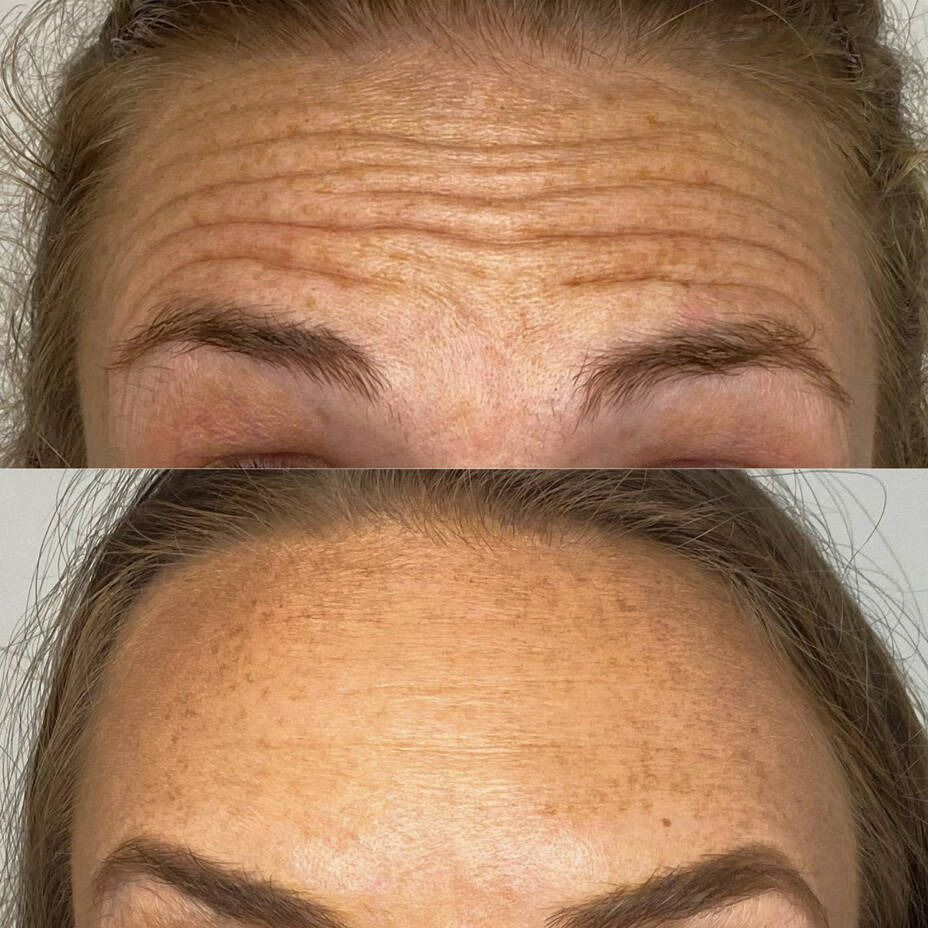 Neurotoxin for Forehead Lines | Before and After Gallery | Beauty Refined