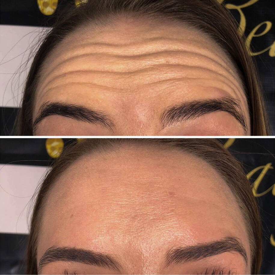 Neurotoxin for Crows Feet | Before and After Gallery