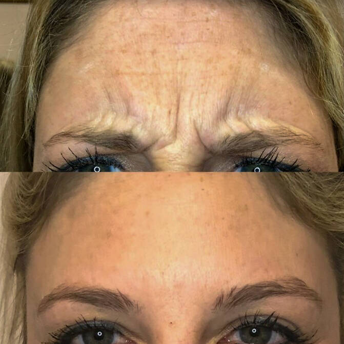 Neurotoxin for Crows Feet | Before and After Gallery