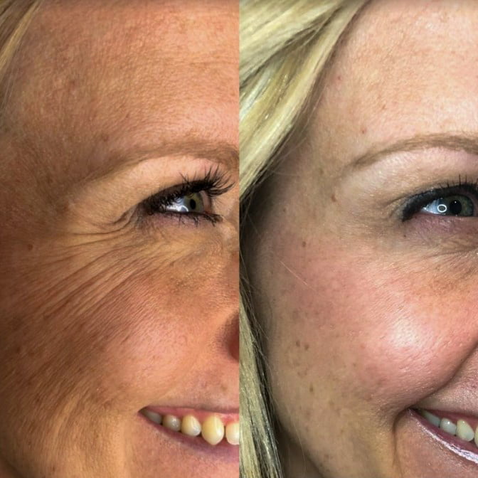 Neurotoxin for Crows Feet | Before and After Gallery