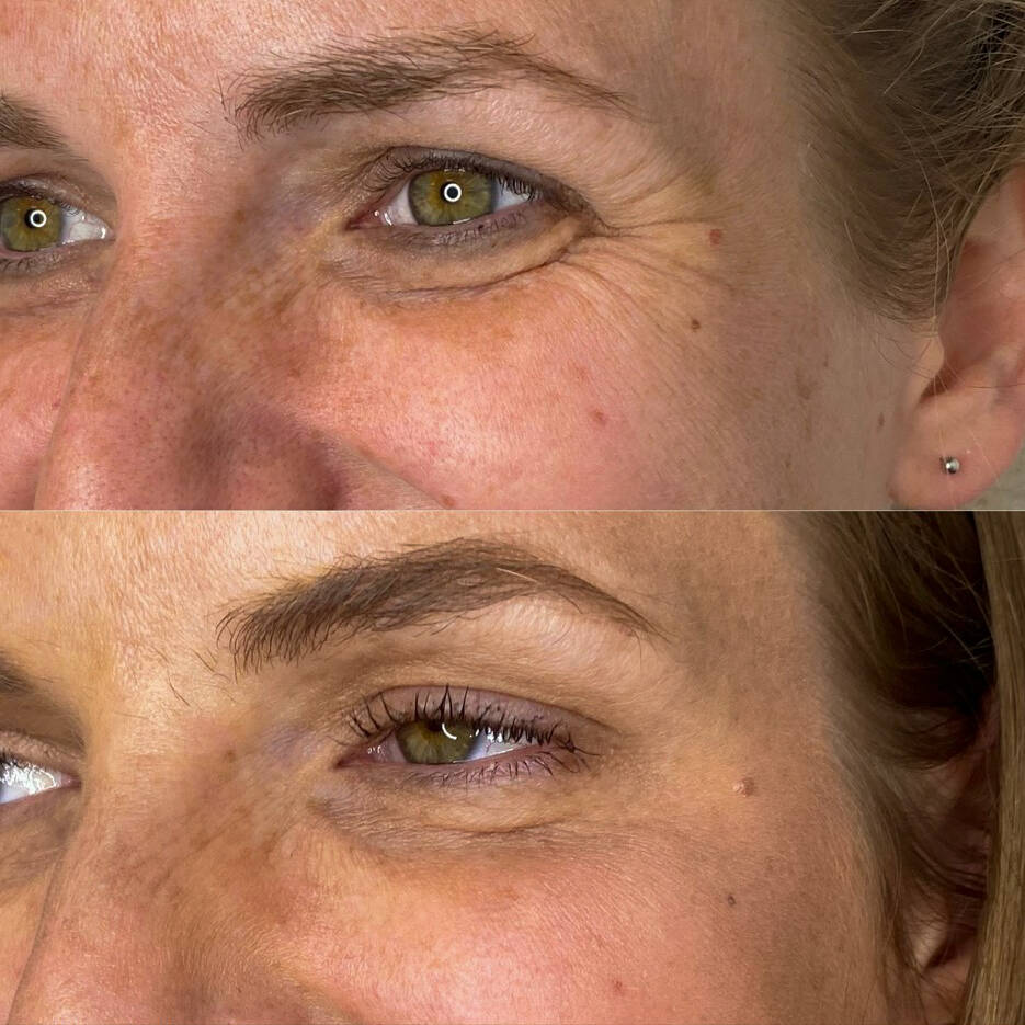 Neurotoxin for Crows Feet | Before and After Gallery