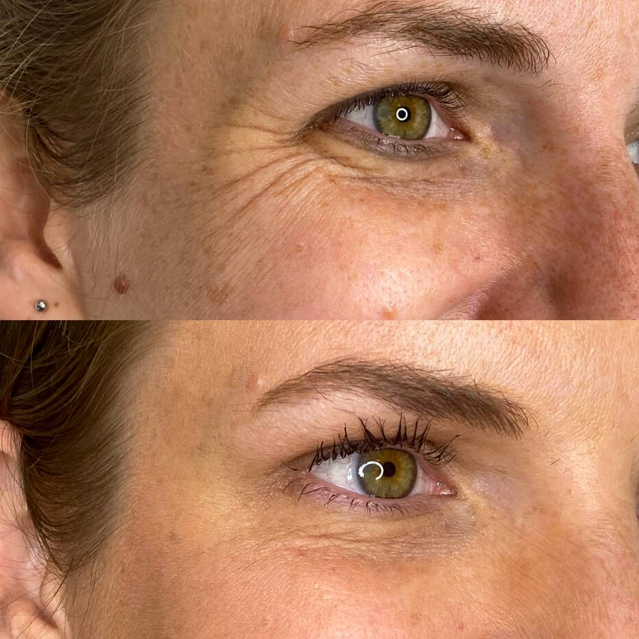 Neurotoxin for Crows Feet | Before and After Gallery | Beauty Refined