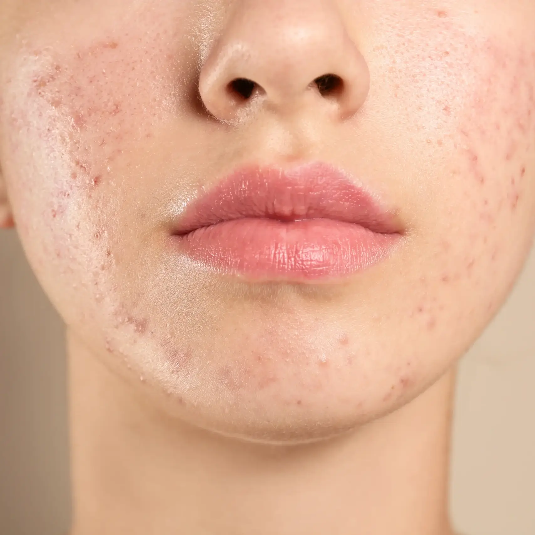 Acne Laser Facial in Greenwood Village & Parker, CO