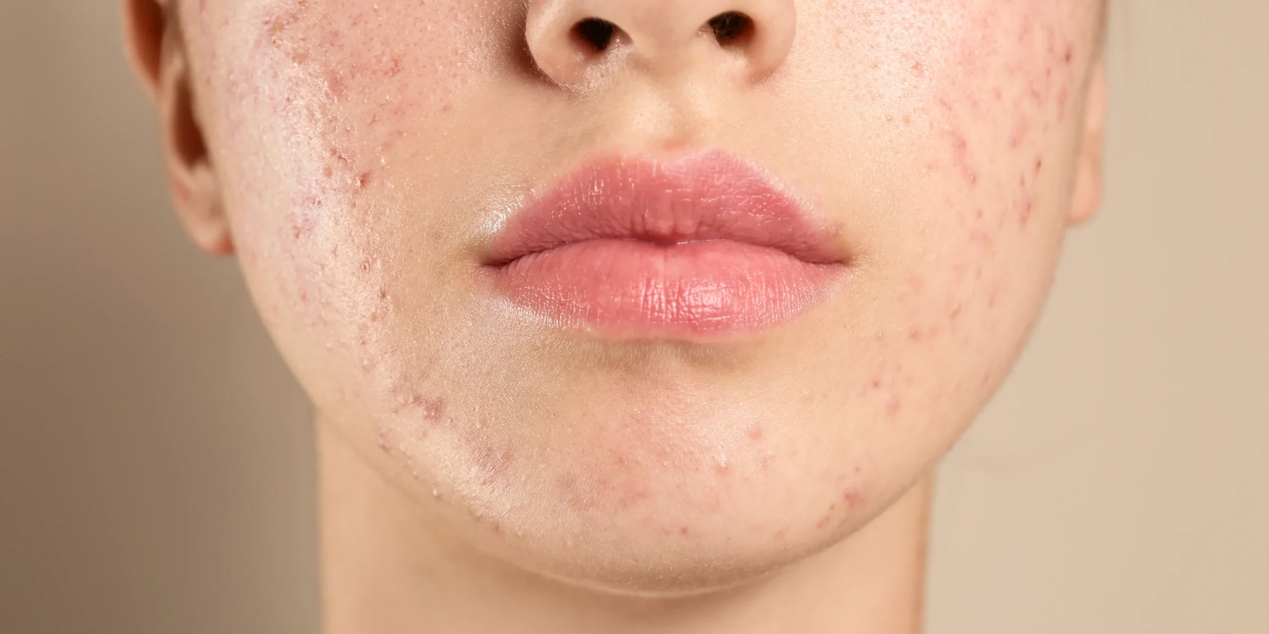 Acne Laser Facial in Greenwood Village & Parker, CO
