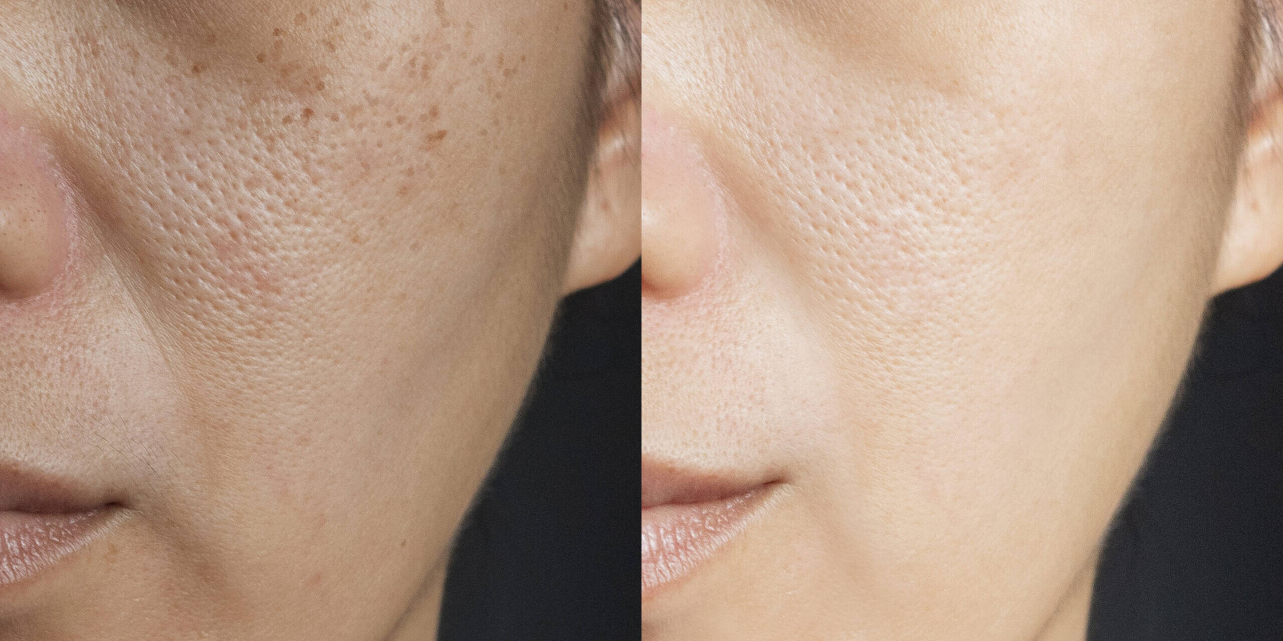 Refined Glow Laser Treatment