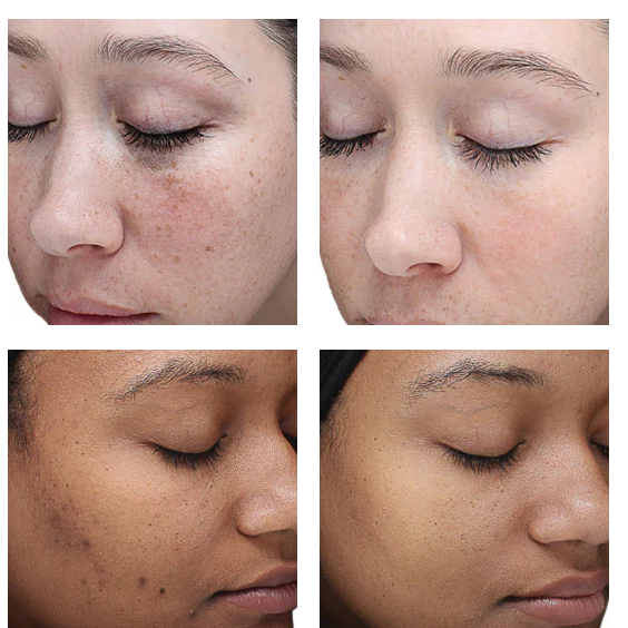 VI Peel Treatments by Beauty Refined