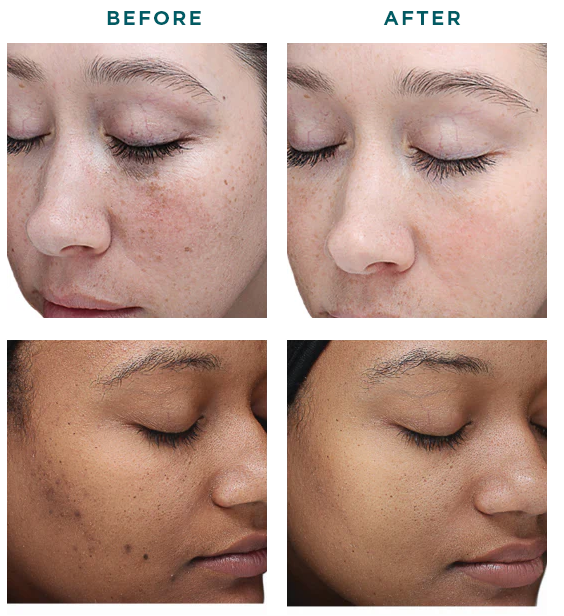 VI Peel Treatments by Beauty Refined