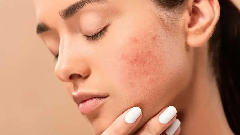 Breakouts Facial for Acne Scars in Greenwood Village, CO by Beauty Refined