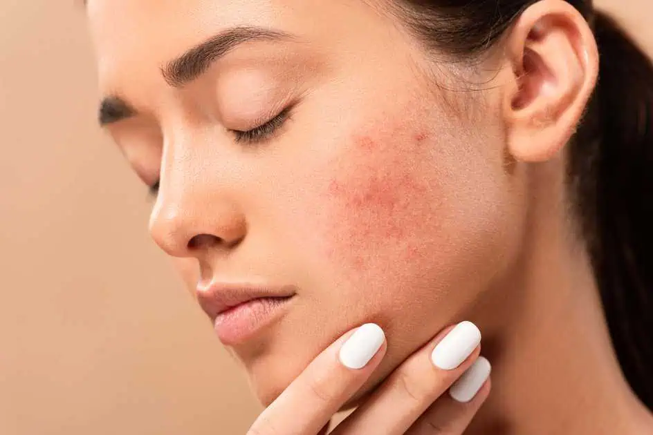 Breakouts Facial for Acne Scars in Greenwood Village, CO by Beauty Refined