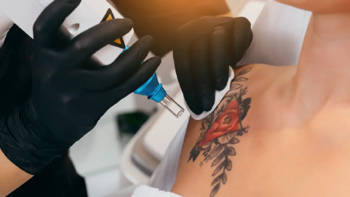 women taking Laser Tattoo Removal in Greenwood Village, CO