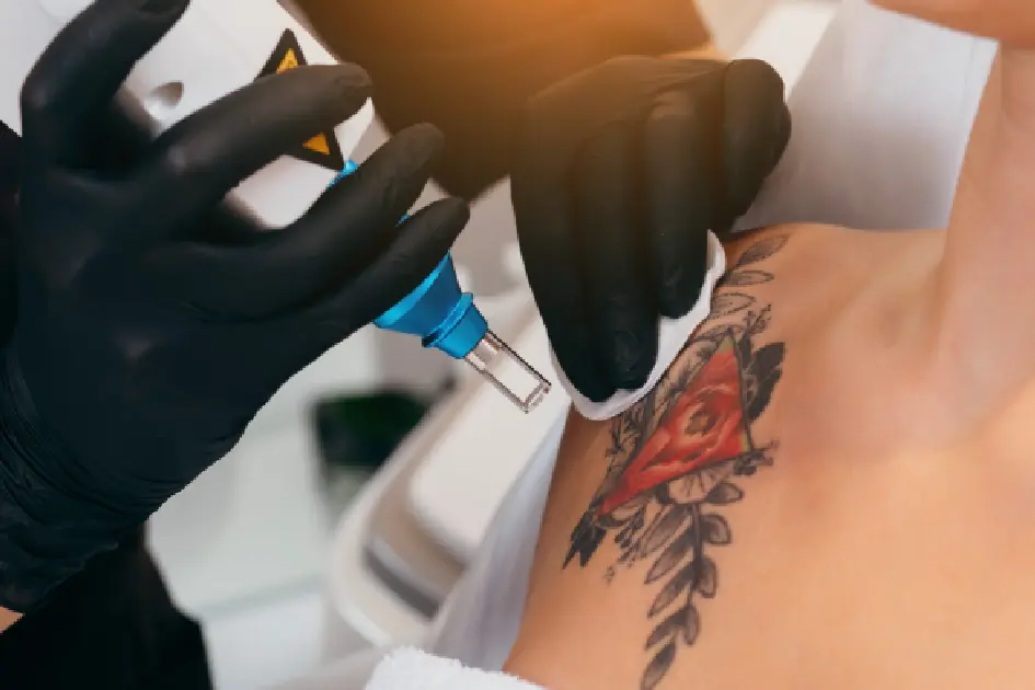women taking Laser Tattoo Removal in Greenwood Village, CO